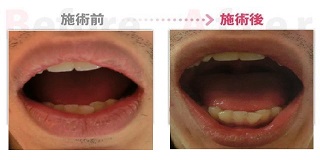 顎関節症改善。（豊田市在住）