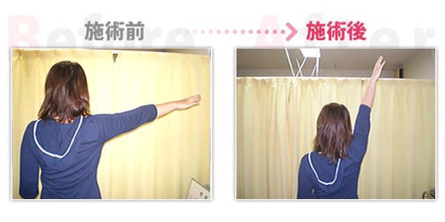 肩の痛み改善。（岡崎市在住）