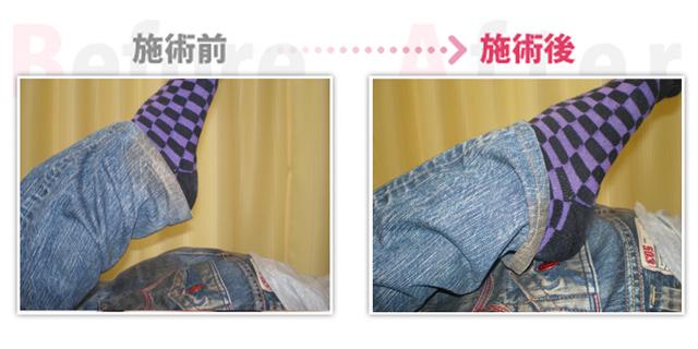 骨盤のゆがみ解消。（治療効果：刈谷市在住）