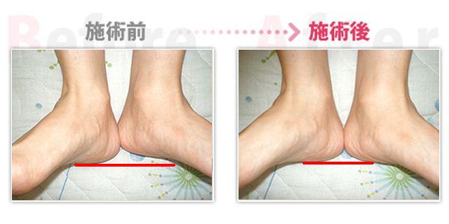 骨盤矯正で頭痛、肩こり、めまい改善。（岡崎市在住）