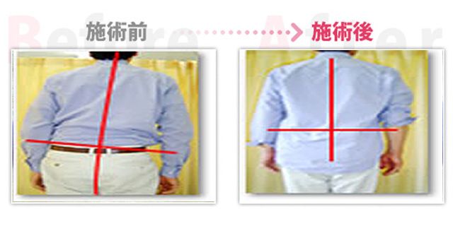 骨盤矯正でヘルニア改善。(碧南市在住