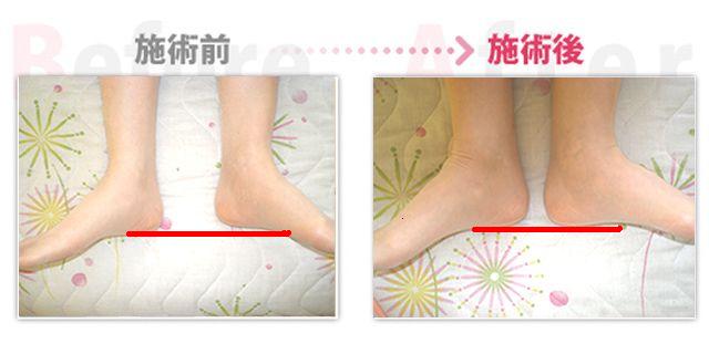 骨盤矯正で腰痛改善。（治療効果：豊田市在住）