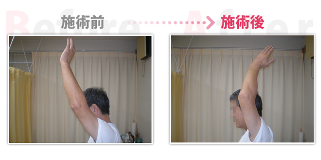 五十肩、肩の痛みが楽になる。（治療効果：碧南市在住）