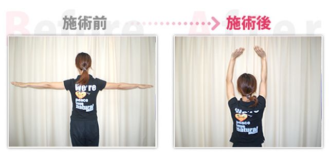 肩の痛み改善。（岡崎市在住）